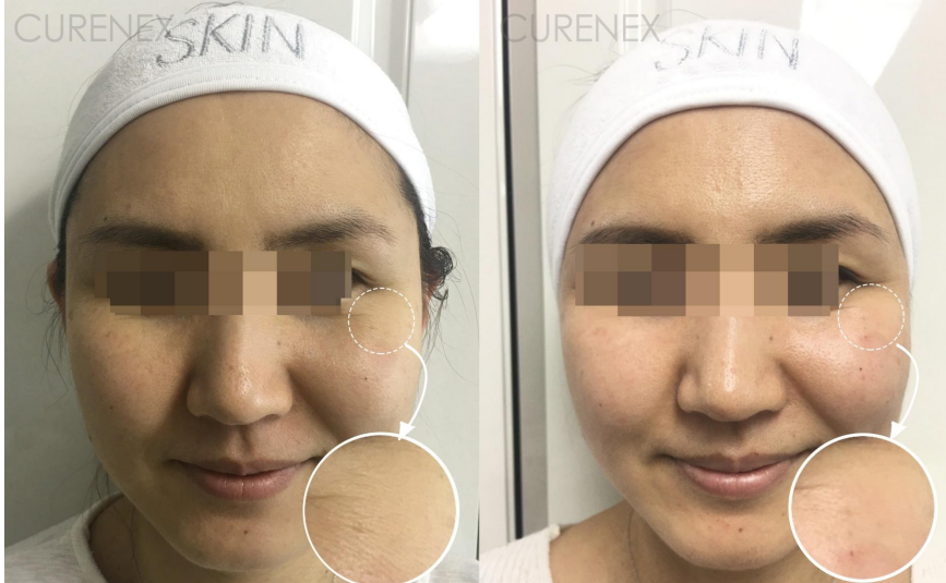 Curenex Skin Booster before and after
