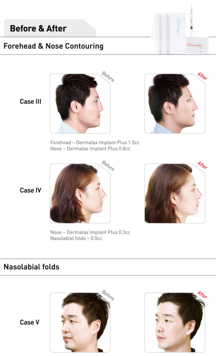 Dermalax forehead and nose contouring before and after
