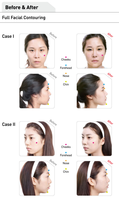 Dermalax full facial contouring before and after