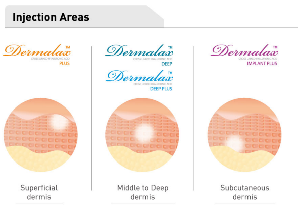 Dermalax injection areas